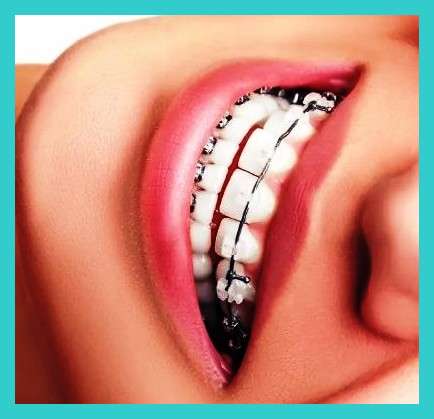 انواع بریس دندان + ثابت جدا شدنی در سال 2023