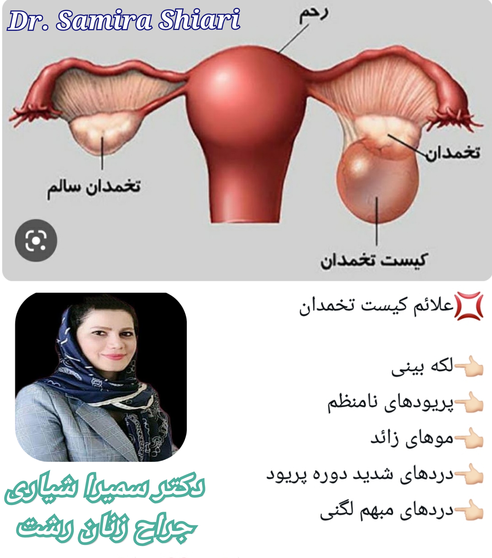 جراح زنان برای کیست تخمدان در رشت