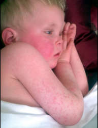 تب مخملک در کودکان؛ علائم، درمان استاندارد و خطرات عدم درمان