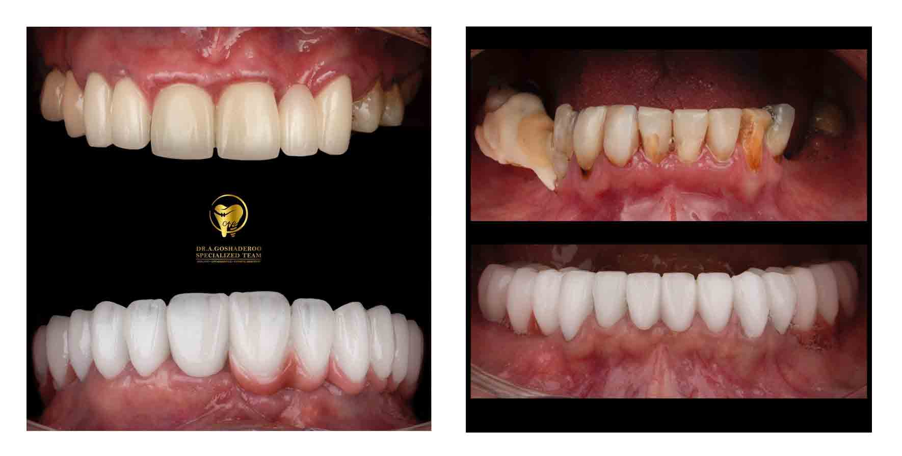 نمونه درمان روکش دندان