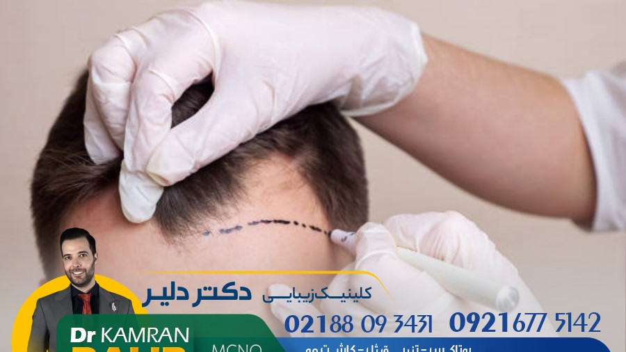 کاشت مو قسطی، با روش نقطه‌ای یا تک به تک توسط دکتر کامران دلیر