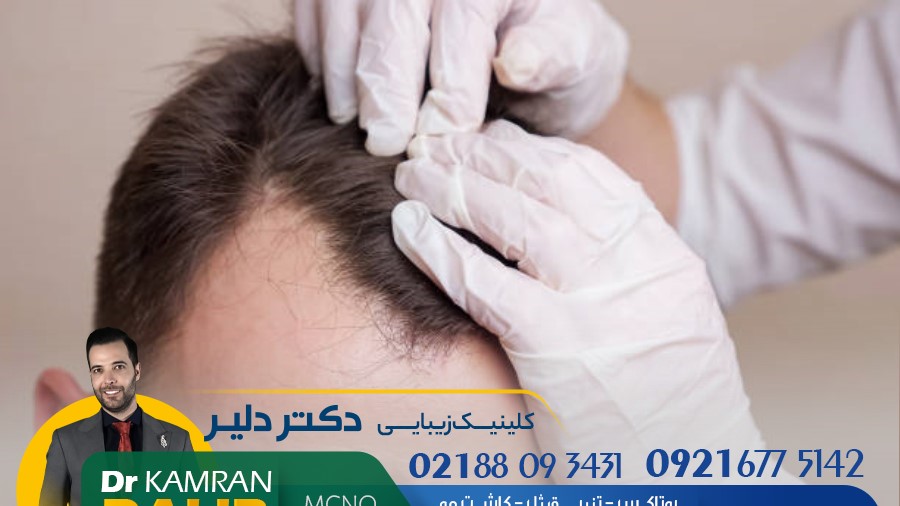 کاشت مو با پرداخت اقساط، با روش نقطه‌ای FUT توسط دکتر کامران دلیر