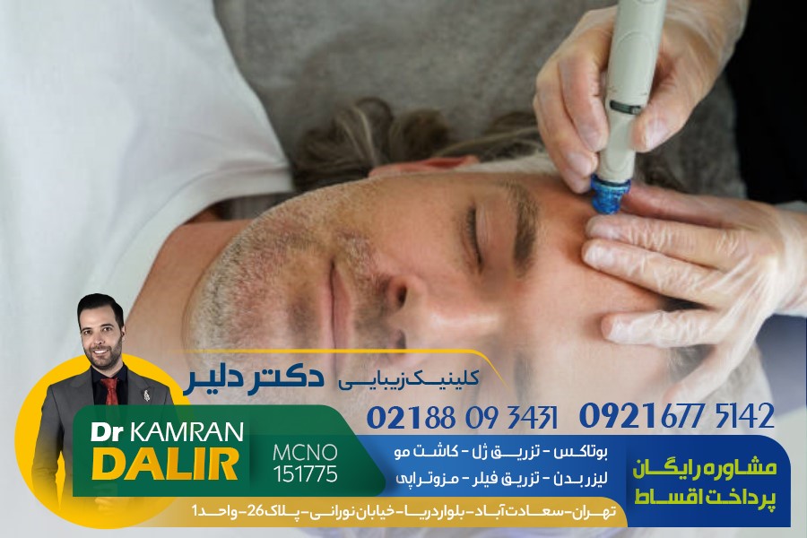 کاشت مو با روش E-FUE توسط دکتر دلیر